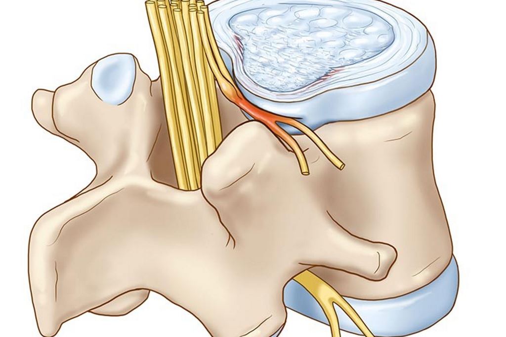 ernia-del-disco