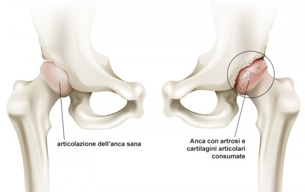 anca-artrosi