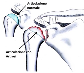 artrosi-spalla