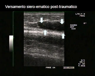 ecografia-trauma