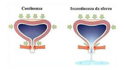 incontinenza-da-sforzo