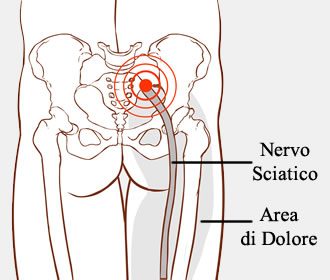 dolore-sciatica